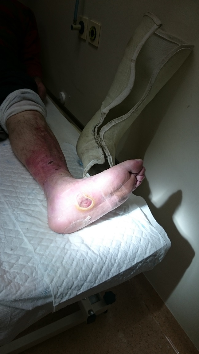 Kronična rana na stopalu povročena zaradi spremenjene arhitektonike stopala